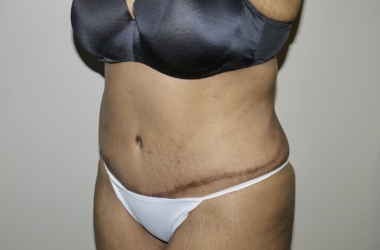 After Image: Abdominoplasty - left-front-oblique