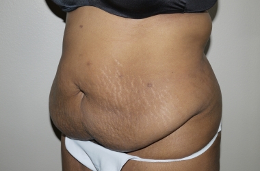 Before Image: Abdominoplasty - left-front-oblique
