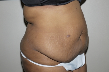 Before Image: Abdominoplasty - right-front-oblique