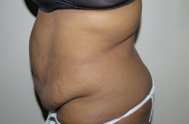 Before Image: Abdominoplasty - left-side