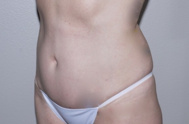 After Image: Abdominoplasty - left-front-oblique