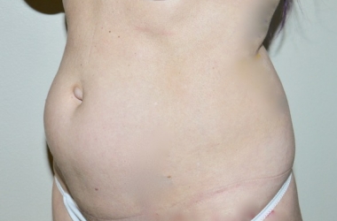 Before Image: Abdominoplasty - left-front-oblique