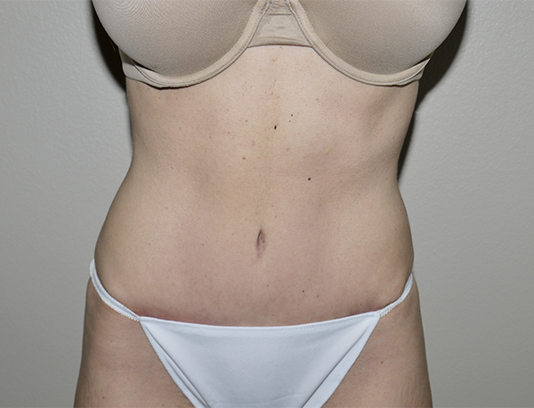 After Image: Abdominoplasty - front