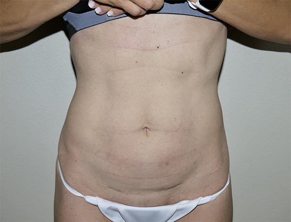 Before Image: Abdominoplasty - front