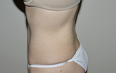 After Image: Abdominoplasty - left-side