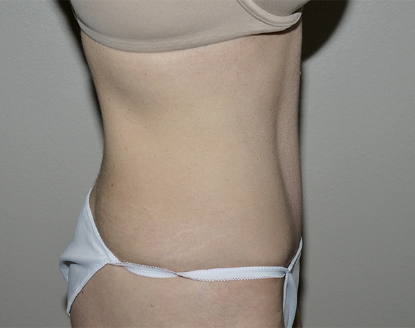 After Image: Abdominoplasty - right-side