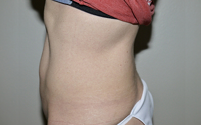 Before Image: Abdominoplasty - left-side