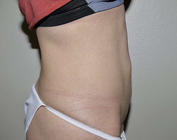 Before Image: Abdominoplasty - right-side