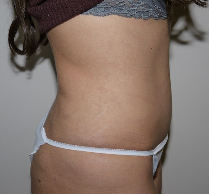 After Image: Abdominoplasty - right-side