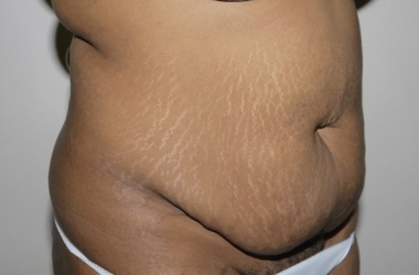 Before Image: Abdominoplasty - right-front-oblique
