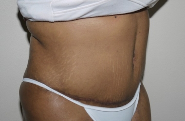 After Image: Abdominoplasty - right-front-oblique