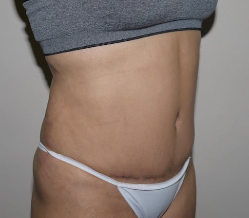 After Image: Abdominoplasty - right-front-oblique
