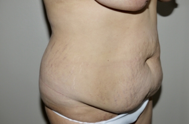 Before Image: Abdominoplasty - right-front-oblique