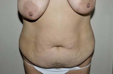 Before Image: Abdominoplasty - front