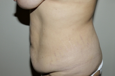 Before Image: Abdominoplasty - left-side