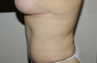 After Image: Abdominoplasty - left-side