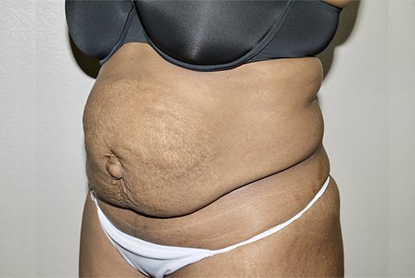 Before Image: Abdominoplasty - left-front-oblique