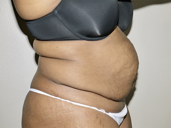 Before Image: Abdominoplasty - right-side