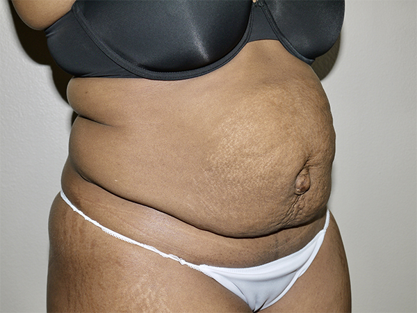 Before Image: Abdominoplasty - right-front-oblique