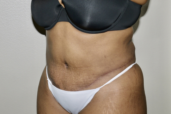 After Image: Abdominoplasty - left-front-oblique