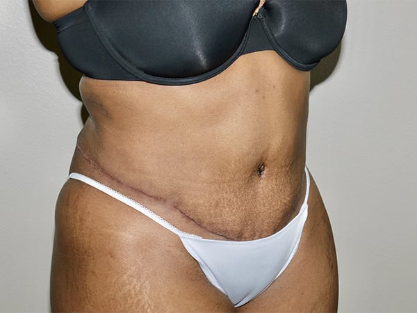 After Image: Abdominoplasty - right-front-oblique