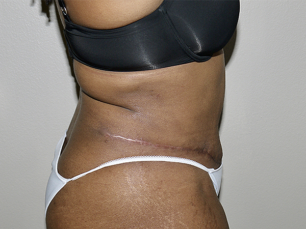 After Image: Abdominoplasty - right-side