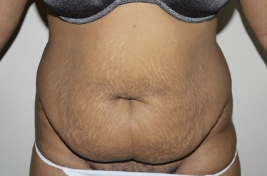 Before Image: Abdominoplasty - front