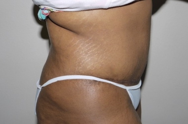 After Image: Abdominoplasty - right-side