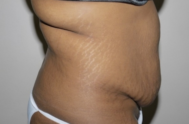 Before Image: Abdominoplasty - right-side