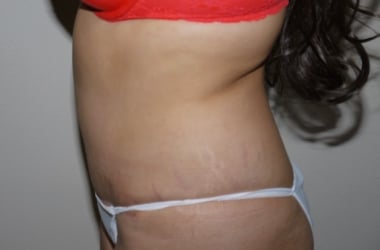 After Image: Abdominoplasty - left-side