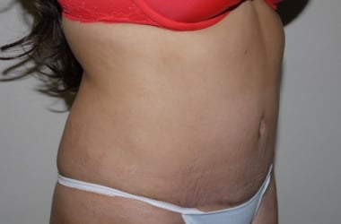 After Image: Abdominoplasty - right-front-oblique