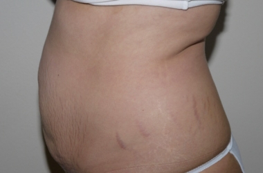Before Image: Abdominoplasty - left-side