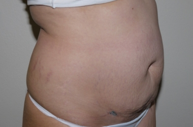 Before Image: Abdominoplasty - right-front-oblique