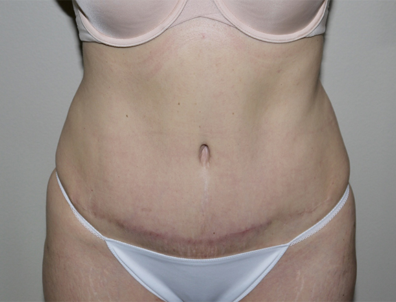 After Image: Abdominoplasty - front