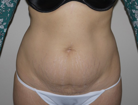 Before Image: Abdominoplasty - front