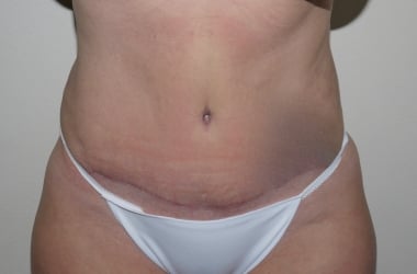 After Image: Abdominoplasty - front