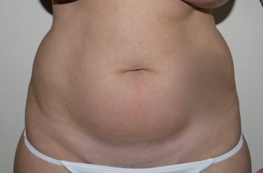 Before Image: Abdominoplasty - front
