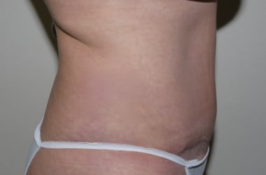 After Image: Abdominoplasty - right-side