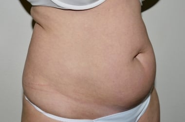 Before Image: Abdominoplasty - front