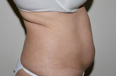 Before Image: Abdominoplasty - right-side