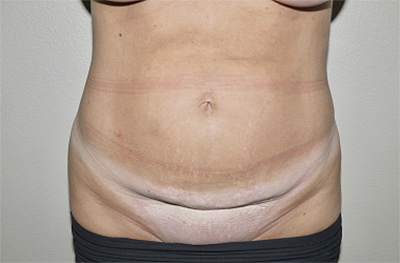 Before Image: Abdominoplasty - front