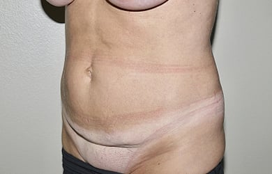 Before Image: Abdominoplasty - left-front-oblique