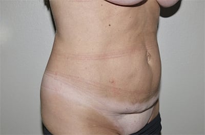 Before Image: Abdominoplasty - right-front-oblique