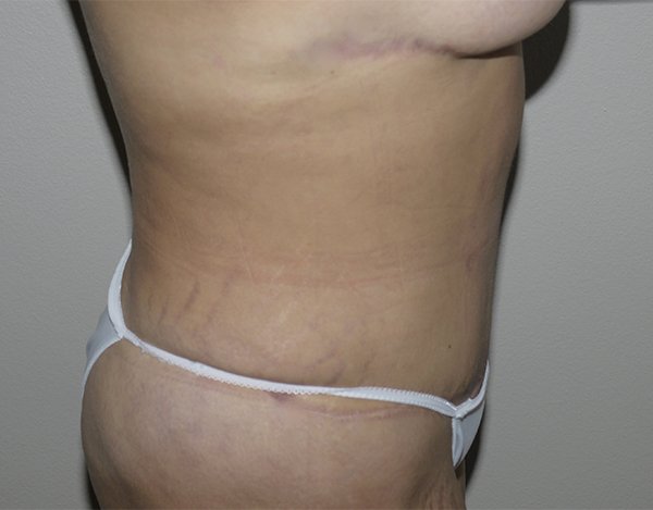 After Image: Abdominoplasty - right-side