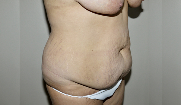 Before Image: Abdominoplasty - right-front-oblique