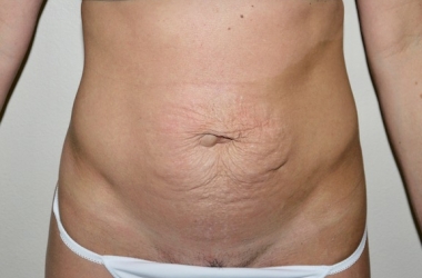 Before Image: Abdominoplasty - front