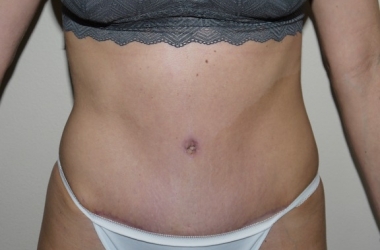 After Image: Abdominoplasty - front