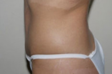 After Image: Abdominoplasty - left-side