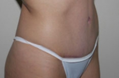 After Image: Abdominoplasty - right-front-oblique