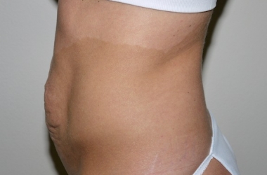 Before Image: Abdominoplasty - left-side